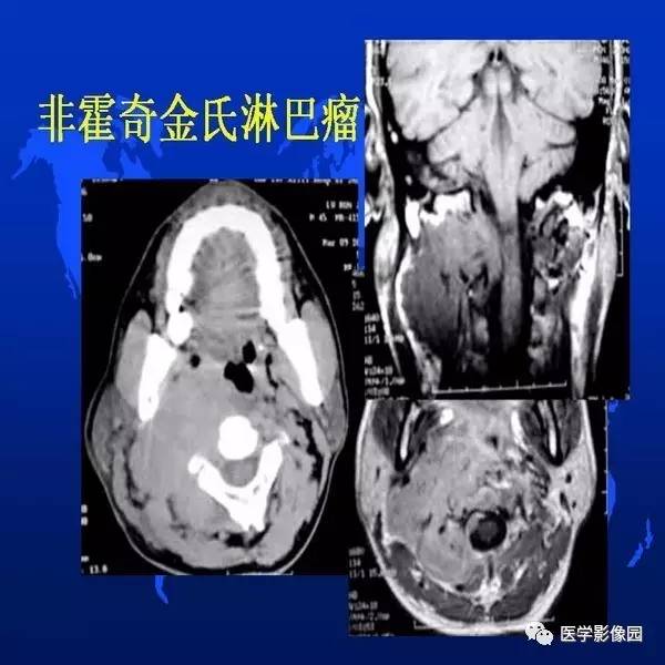 【PPT】鼻咽病变诊断与鉴别诊断