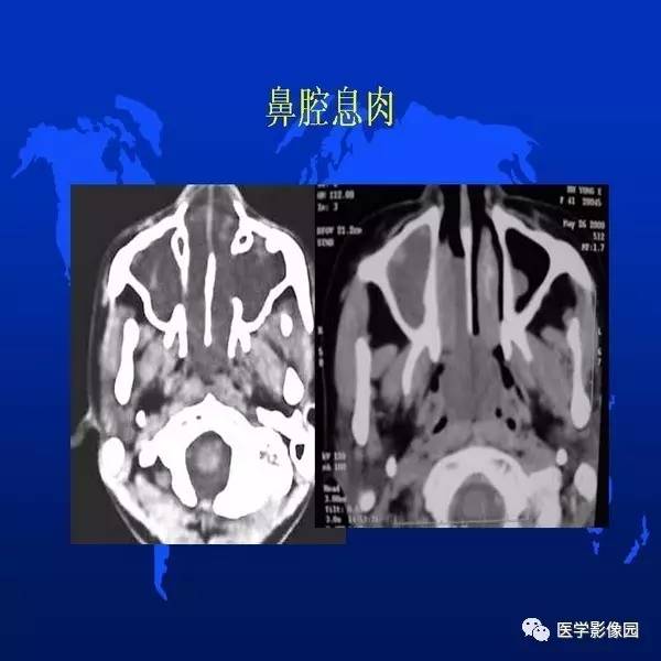 【PPT】鼻咽病变诊断与鉴别诊断