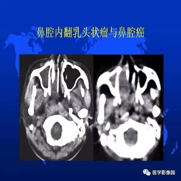 【PPT】鼻咽病变诊断与鉴别诊断