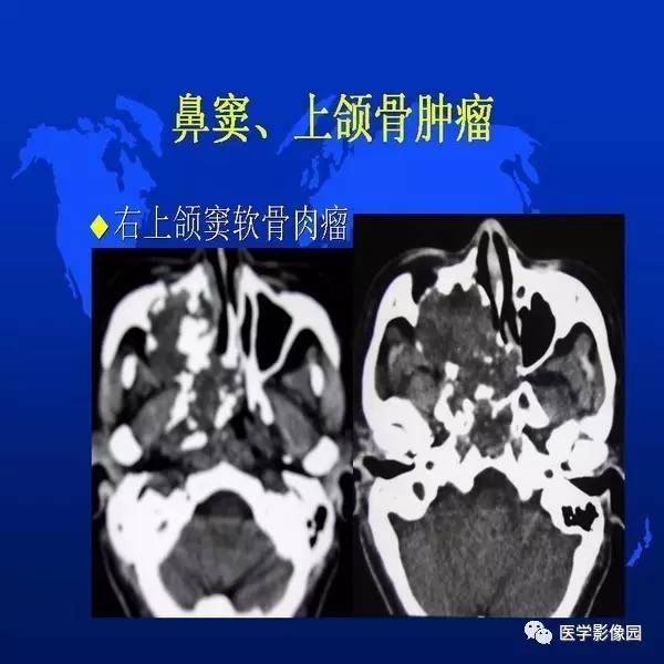 【PPT】鼻咽病变诊断与鉴别诊断