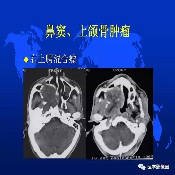 【PPT】鼻咽病变诊断与鉴别诊断