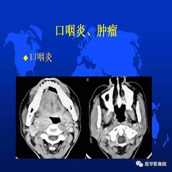 【PPT】鼻咽病变诊断与鉴别诊断