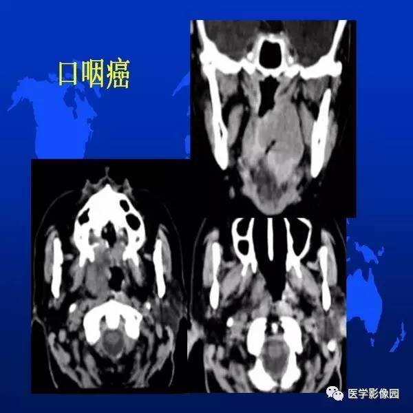 【PPT】鼻咽病变诊断与鉴别诊断