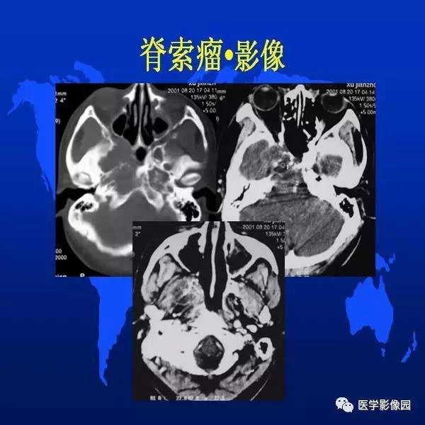 【PPT】鼻咽病变诊断与鉴别诊断