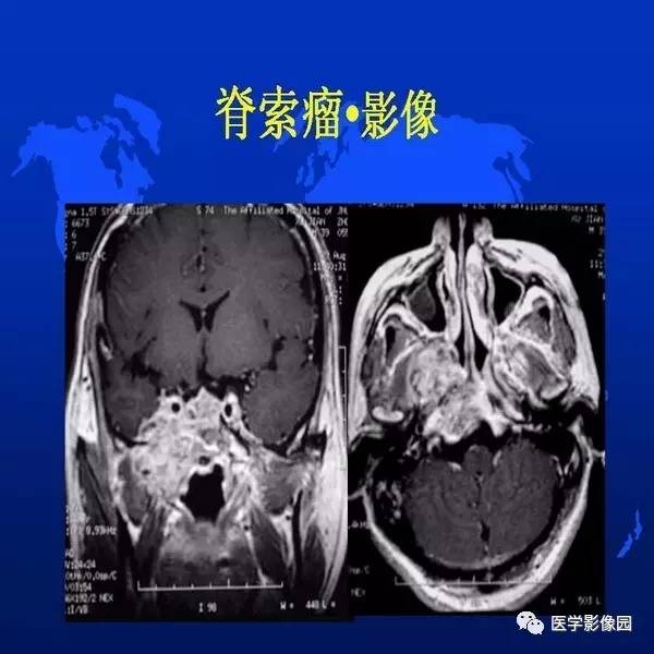 【PPT】鼻咽病变诊断与鉴别诊断