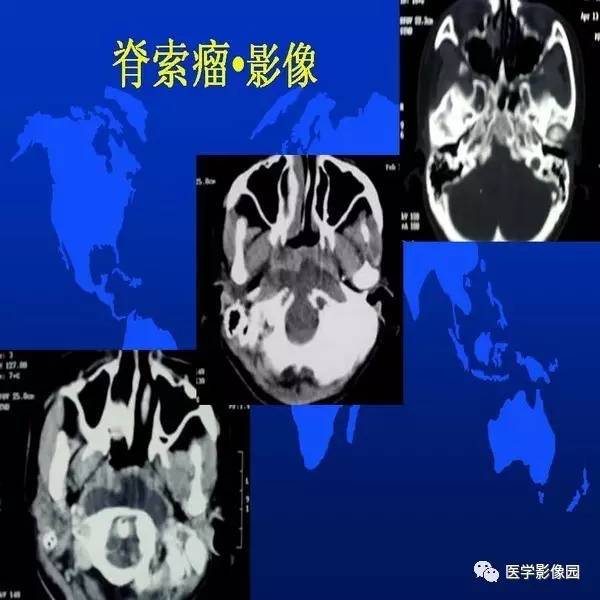 【PPT】鼻咽病变诊断与鉴别诊断
