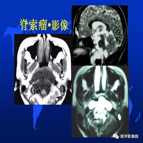 【PPT】鼻咽病变诊断与鉴别诊断