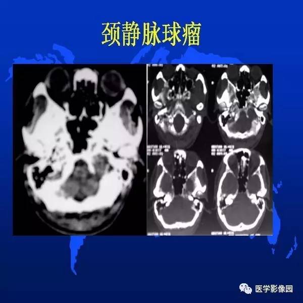 【PPT】鼻咽病变诊断与鉴别诊断
