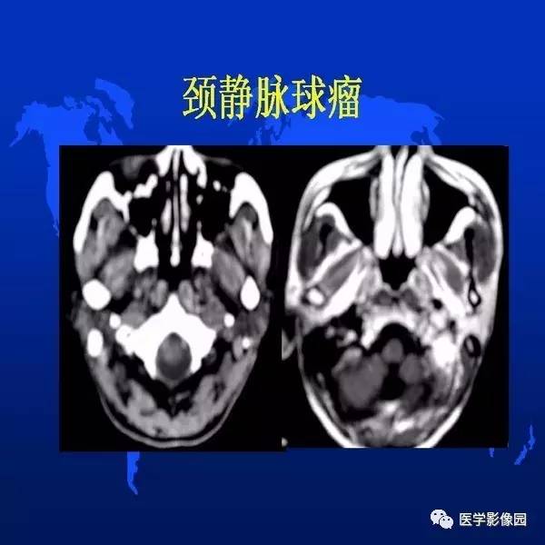 【PPT】鼻咽病变诊断与鉴别诊断
