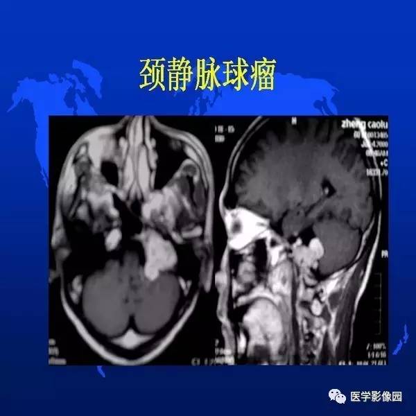 【PPT】鼻咽病变诊断与鉴别诊断