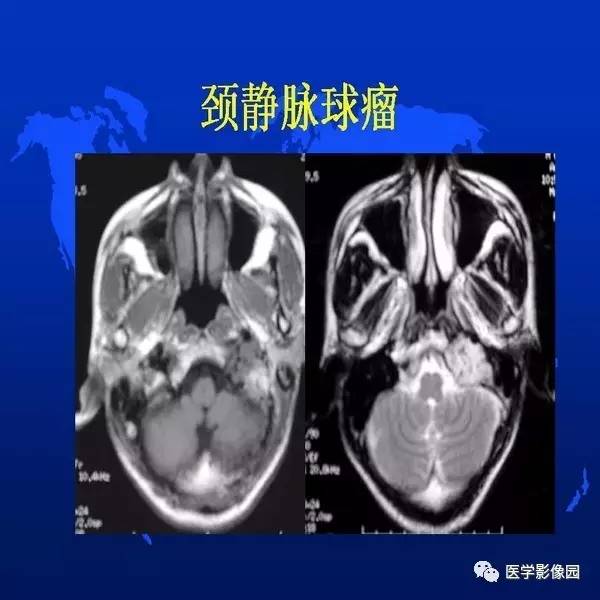 【PPT】鼻咽病变诊断与鉴别诊断