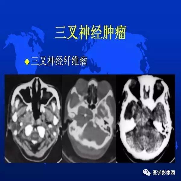 【PPT】鼻咽病变诊断与鉴别诊断