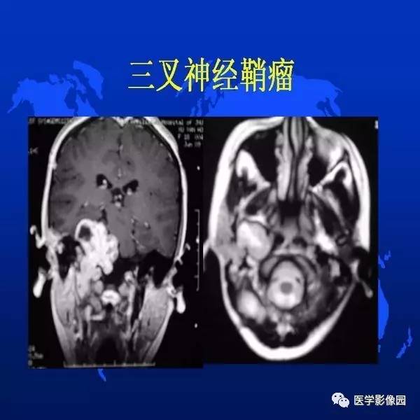 【PPT】鼻咽病变诊断与鉴别诊断