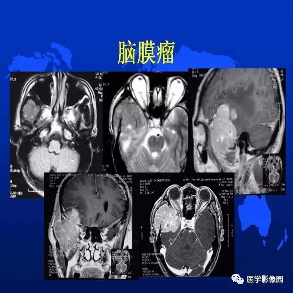 【PPT】鼻咽病变诊断与鉴别诊断