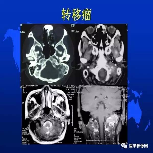 【PPT】鼻咽病变诊断与鉴别诊断