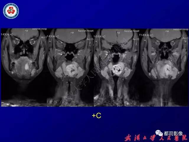 【PPT】舌部良恶性病变及鉴别诊断