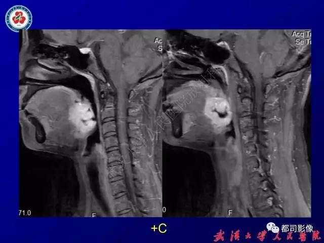 【PPT】舌部良恶性病变及鉴别诊断