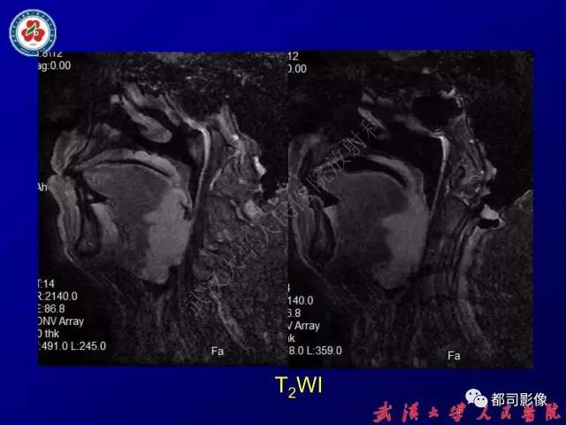 【PPT】舌部良恶性病变及鉴别诊断