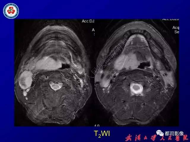 【PPT】舌部良恶性病变及鉴别诊断