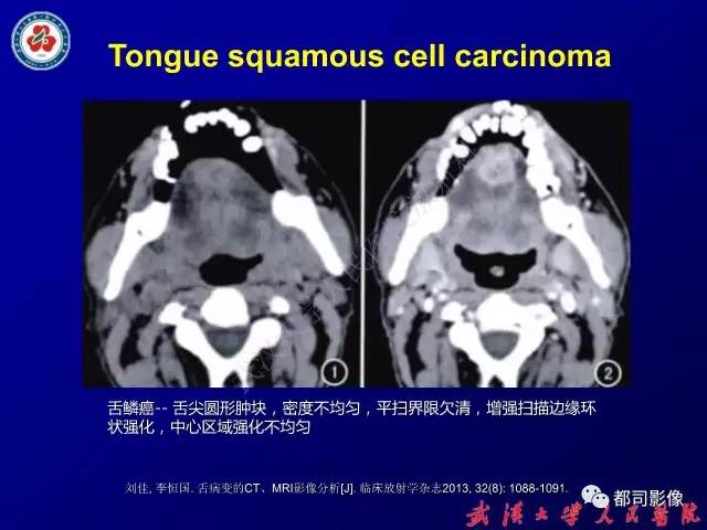 【PPT】舌部良恶性病变及鉴别诊断