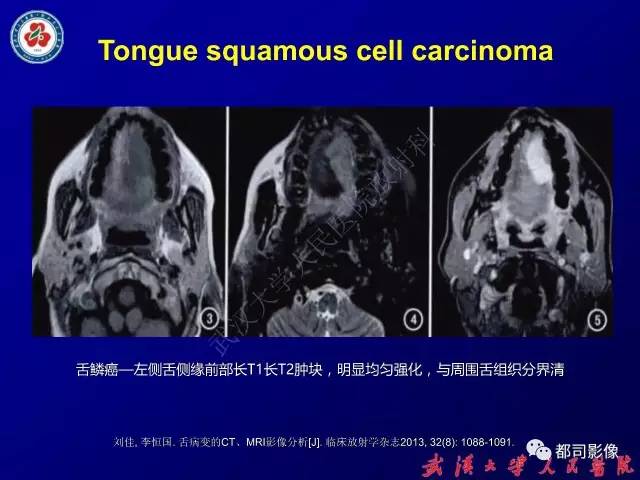 【PPT】舌部良恶性病变及鉴别诊断
