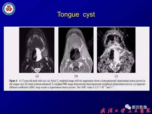 【PPT】舌部良恶性病变及鉴别诊断
