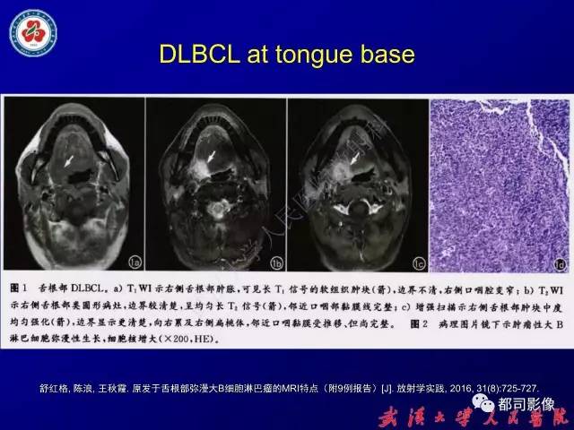 【PPT】舌部良恶性病变及鉴别诊断
