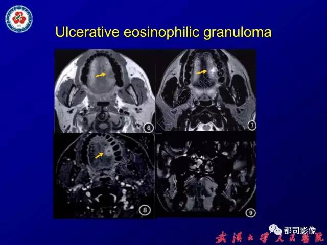 【PPT】舌部良恶性病变及鉴别诊断