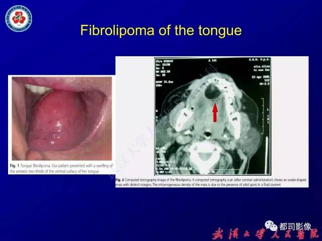 【PPT】舌部良恶性病变及鉴别诊断