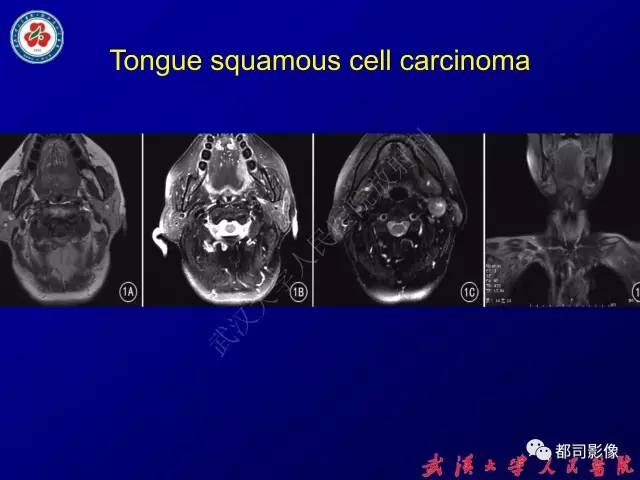 【PPT】舌部良恶性病变及鉴别诊断