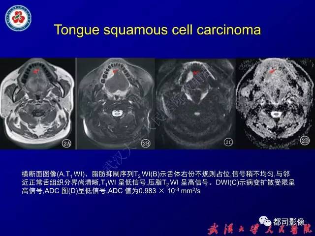 【PPT】舌部良恶性病变及鉴别诊断