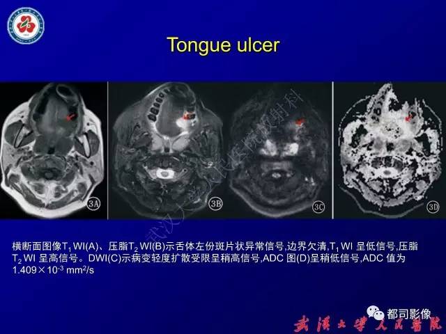 【PPT】舌部良恶性病变及鉴别诊断