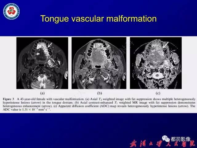 【PPT】舌部良恶性病变及鉴别诊断