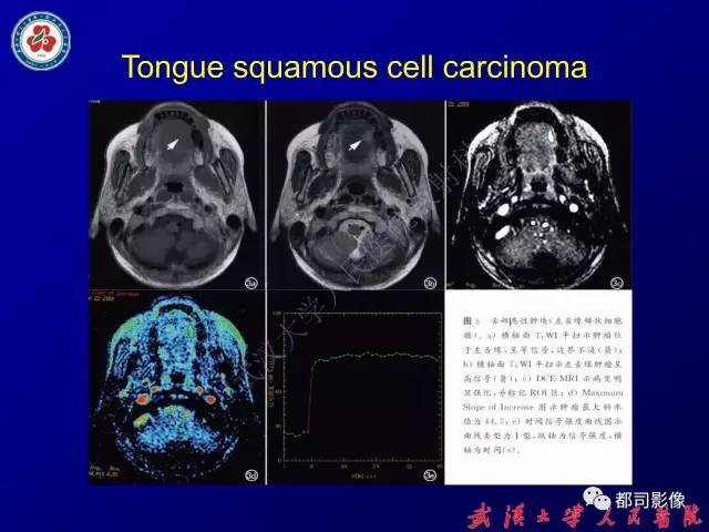 【PPT】舌部良恶性病变及鉴别诊断