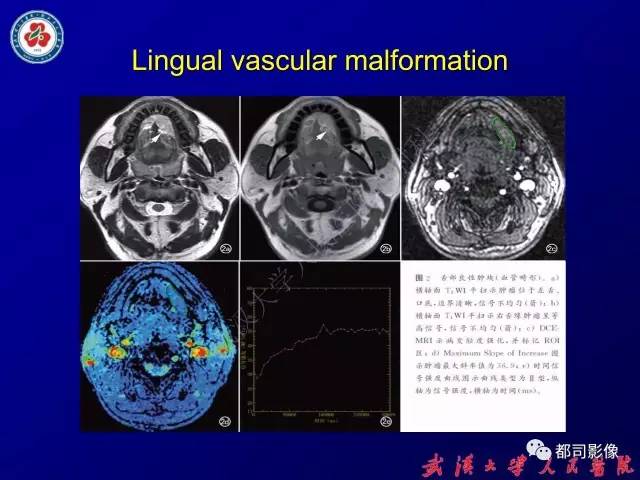 【PPT】舌部良恶性病变及鉴别诊断