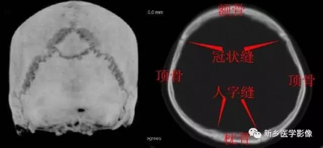 轻松鉴别:板障静脉沟、动脉压迹、骨缝和线形骨折 轻松鉴别:板障静脉沟、动脉压迹、骨缝和线形骨折