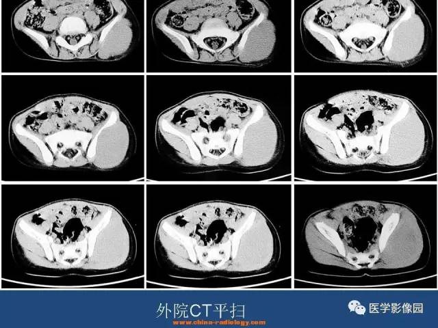 【病例】左臀部腺泡型横纹肌肉瘤1例CT及MR影像表现