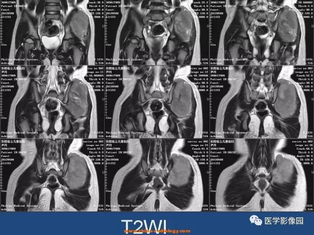 【病例】左臀部腺泡型横纹肌肉瘤1例CT及MR影像表现