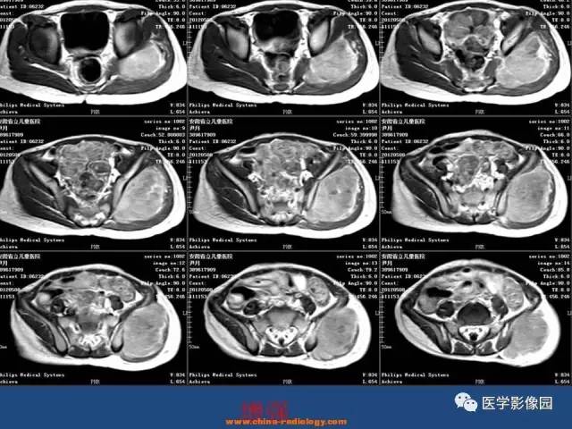 【病例】左臀部腺泡型横纹肌肉瘤1例CT及MR影像表现