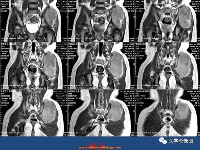 【病例】左臀部腺泡型横纹肌肉瘤1例CT及MR影像表现