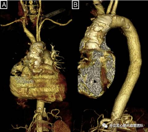 瓷化主动脉procelain aorta 瓷化主动脉procelain aorta
