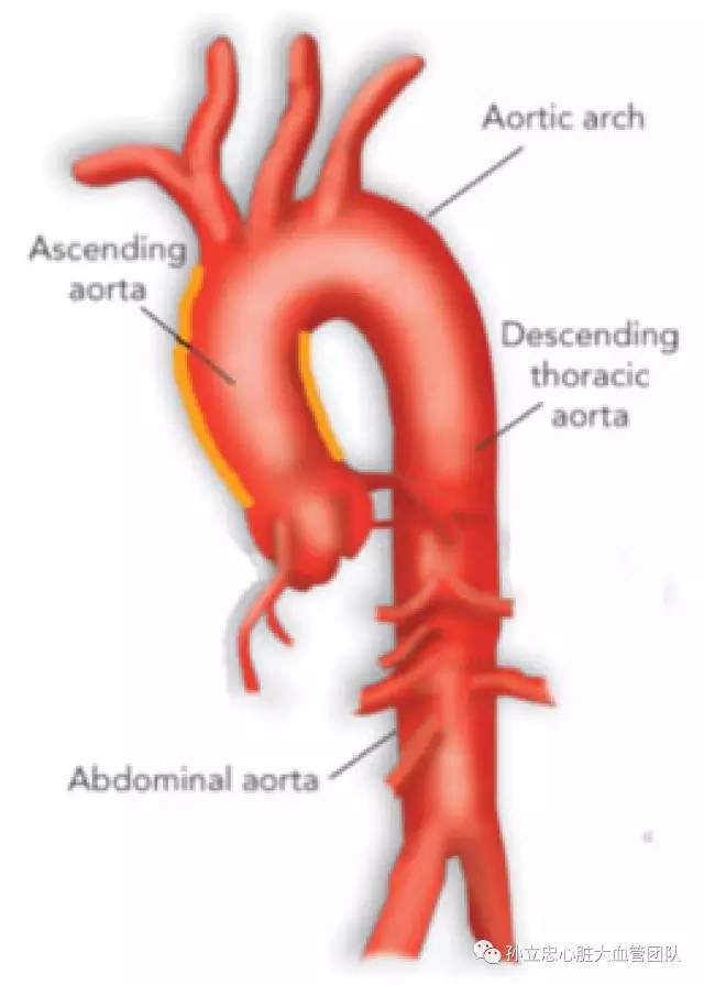 瓷化主动脉procelain aorta 瓷化主动脉procelain aorta