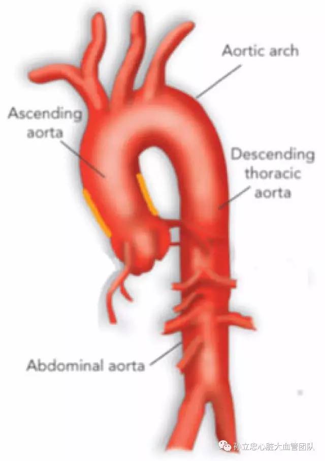 瓷化主动脉procelain aorta 瓷化主动脉procelain aorta