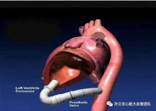 瓷化主动脉procelain aorta 瓷化主动脉procelain aorta