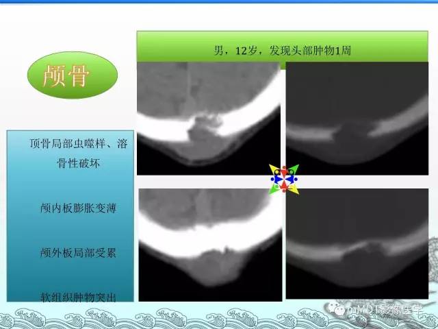 【PPT】骨嗜酸性肉芽肿的影像诊断