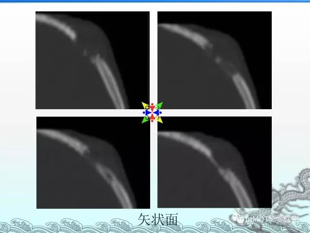 【PPT】骨嗜酸性肉芽肿的影像诊断