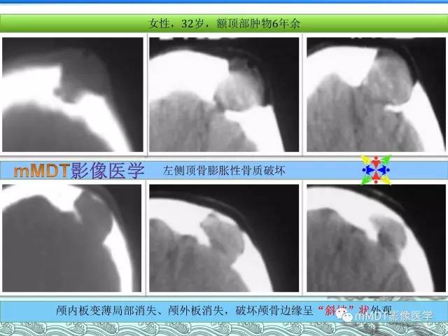 【PPT】骨嗜酸性肉芽肿的影像诊断