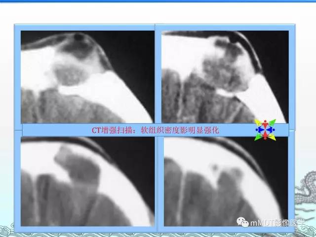 【PPT】骨嗜酸性肉芽肿的影像诊断