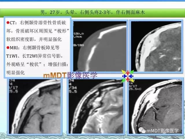 【PPT】骨嗜酸性肉芽肿的影像诊断