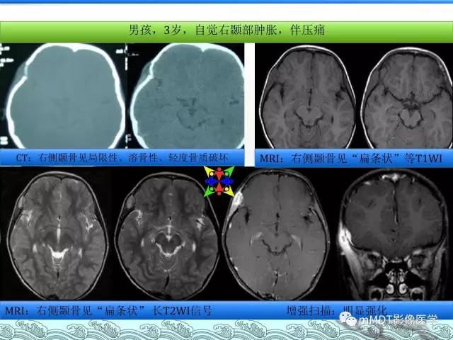 【PPT】骨嗜酸性肉芽肿的影像诊断